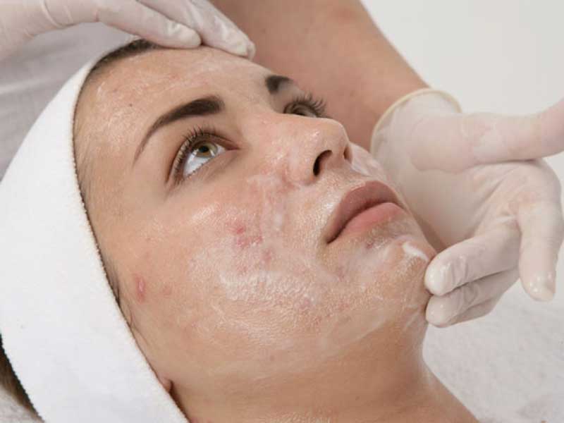 chemical peel treatment in Pakistan