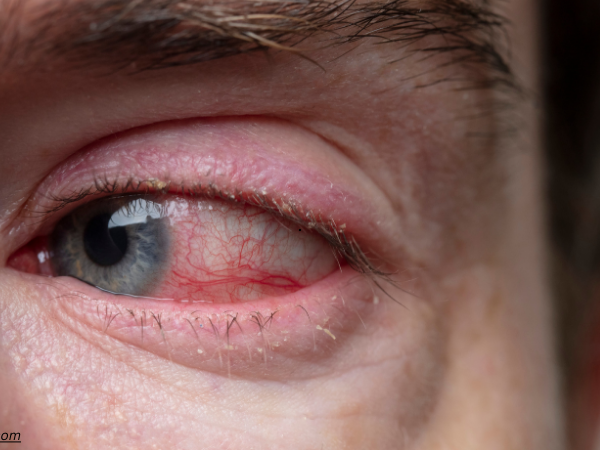 Allergic Conjunctivitis Market Size and Share Report 2024-2032