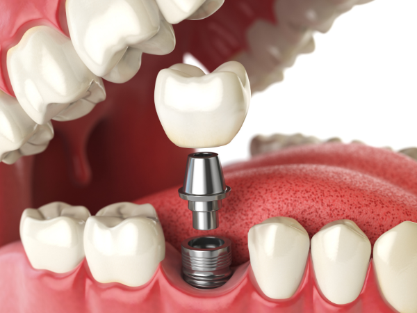 Dental Implants Market Share and Size Forecast Report 2024-2032