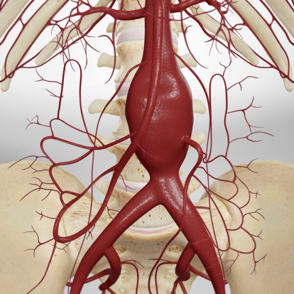 North America Aortic Stent Graft Market