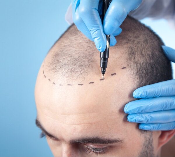 Hair Transplant Clinic in Pune