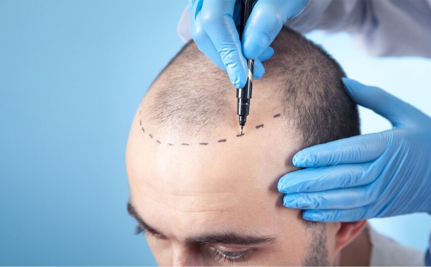 Hair Transplant Clinic in Pune