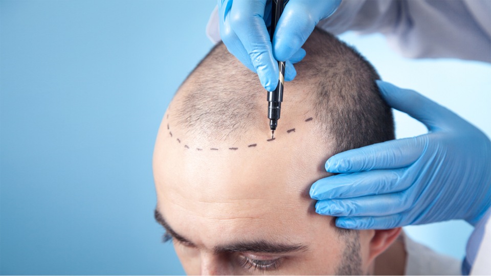 Hair Transplant Clinic in Pune