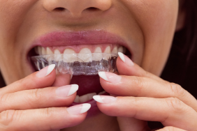 Maintaining Your Invisalign Aligners: Cleaning and Care Tips