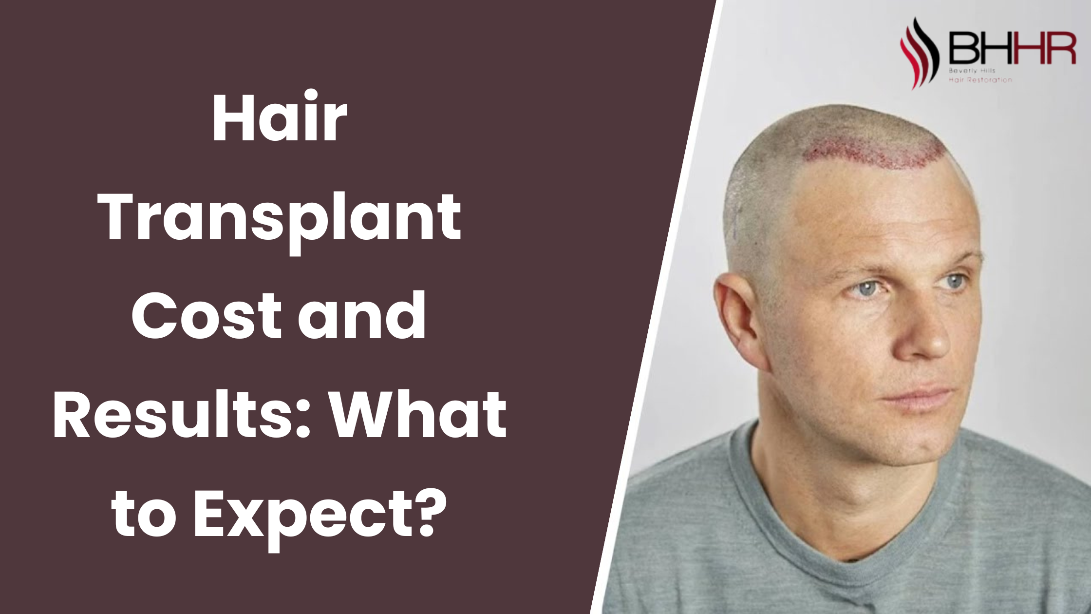 hair transplant cost