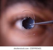 Intraocular Lens Market Size Forecast Report 2024-2032