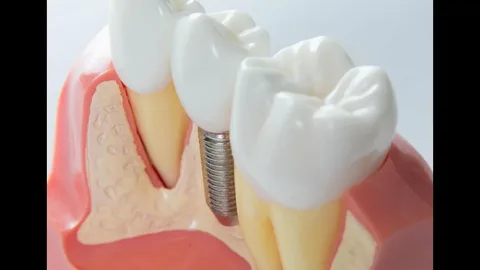 Dental Implants Alexandria